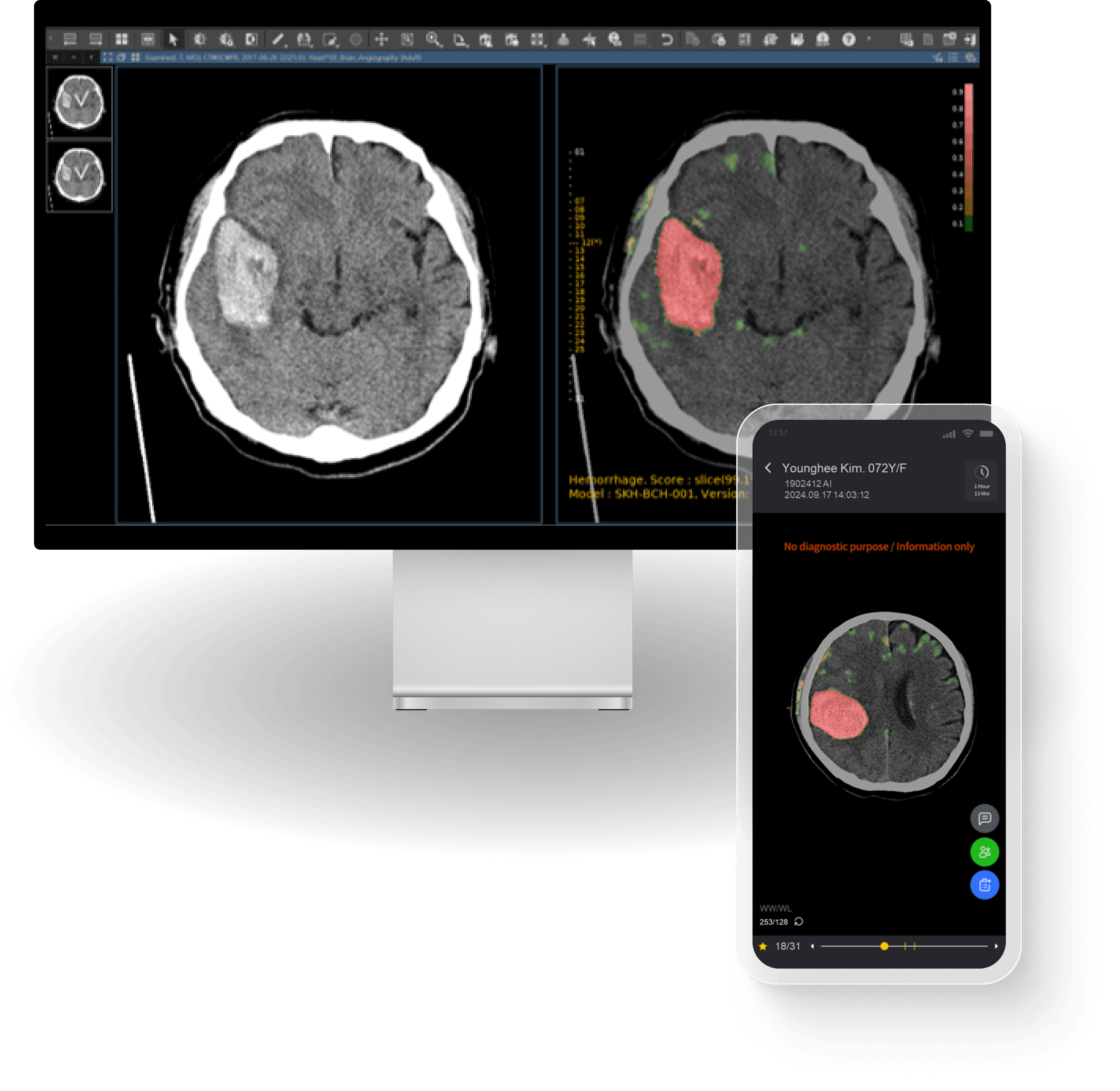 Hemorrhage detection