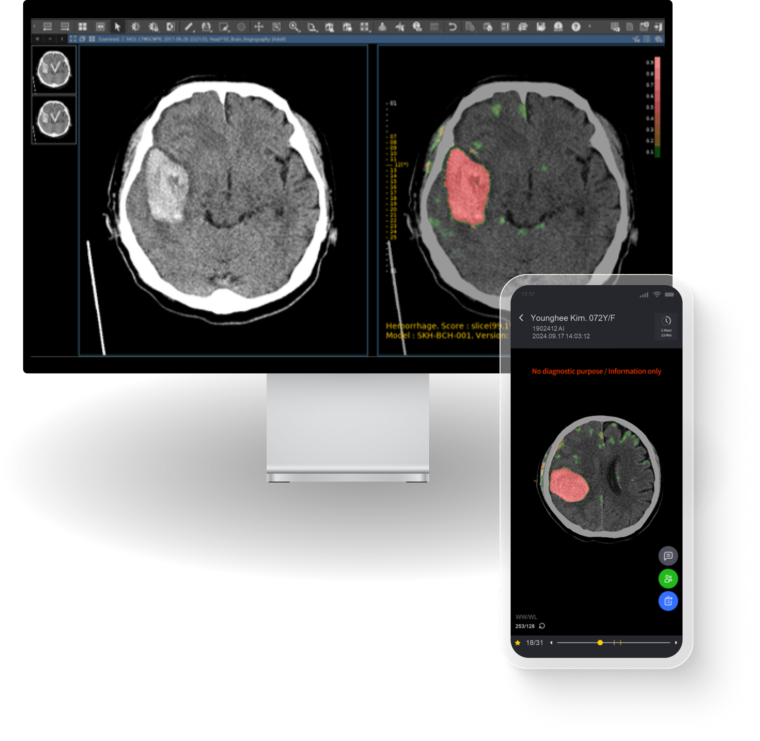 Hemorrhage detection