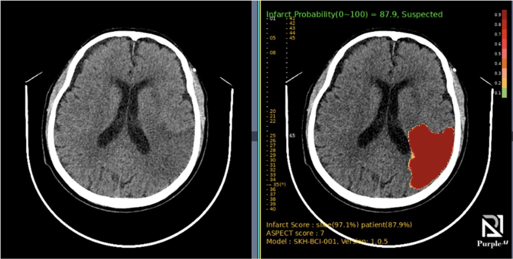 Infarct 1