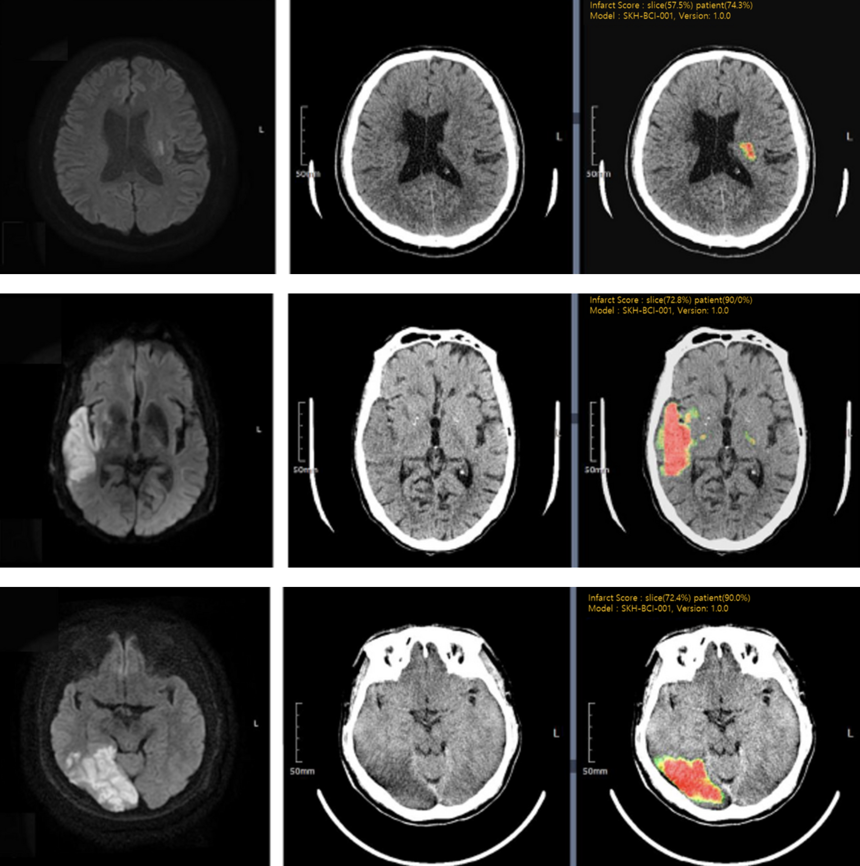 Infarct 2